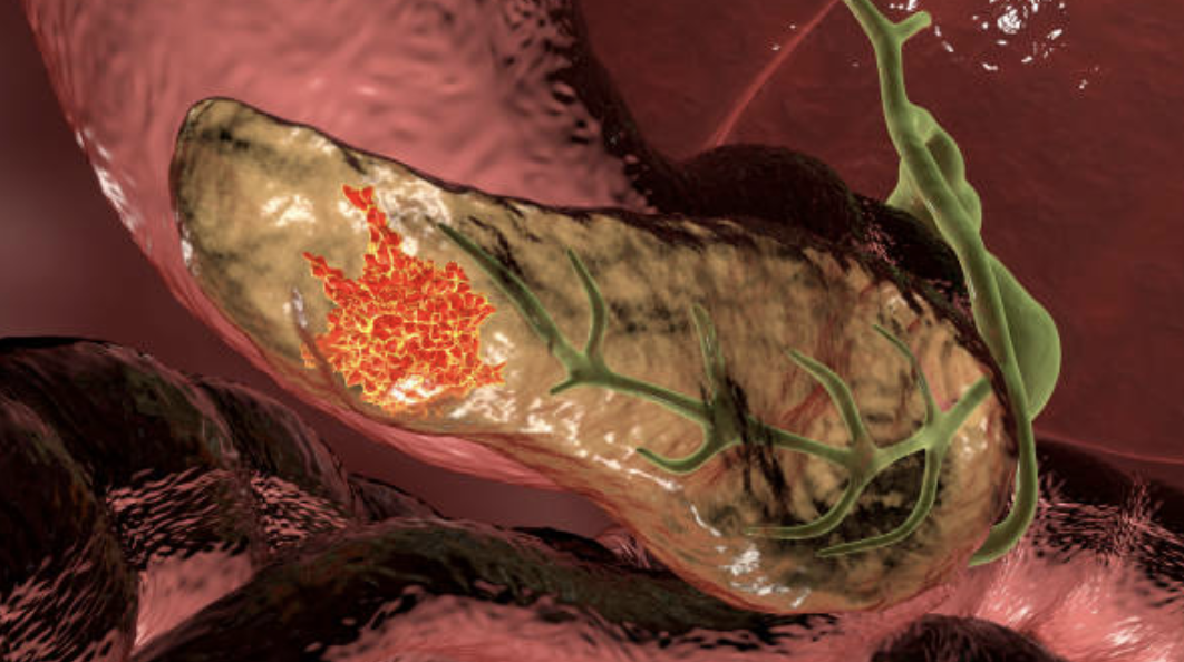 췌장암은 여전히 가장 치명적인 암 중 하나지만, 최근의 연구 성과들은 환자들에게 새로운 희망을 제시하고 있다. ©Getty Images 